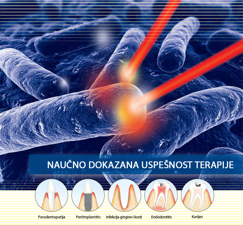 lečenje paradentopatije laserom