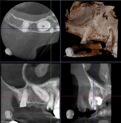 CBCT small FOV teeth 15-11