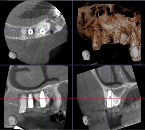 Control CBCT small FOV - 1