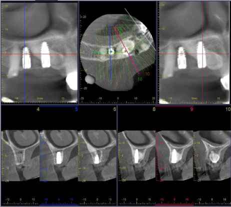 Control CBCT small FOV - 2