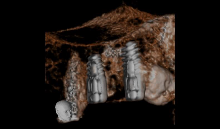 CBCT small FOV slice along Y plane